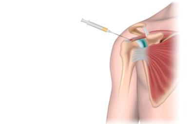 PRP Prolotherapy